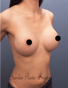 Breast Augmentation After Photo by Marvin Shienbaum, MD; Brandon, FL - Case 45657