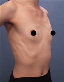 Breast Augmentation Before Photo by Marvin Shienbaum, MD; Brandon, FL - Case 45657