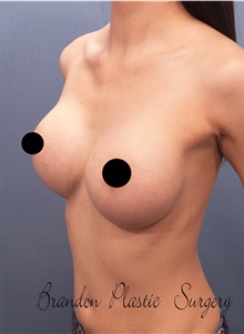 Breast Augmentation After Photo by Marvin Shienbaum, MD; Brandon, FL - Case 45657