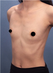 Breast Augmentation Before Photo by Marvin Shienbaum, MD; Brandon, FL - Case 45657