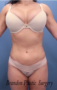 Liposuction After Photo by Marvin Shienbaum, MD; Brandon, FL - Case 45697