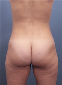 Liposuction Before Photo by Marvin Shienbaum, MD; Brandon, FL - Case 45697