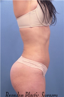 Liposuction After Photo by Marvin Shienbaum, MD; Brandon, FL - Case 45697