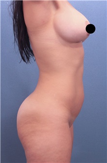 Liposuction Before Photo by Marvin Shienbaum, MD; Brandon, FL - Case 45697