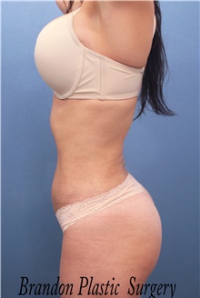 Liposuction After Photo by Marvin Shienbaum, MD; Brandon, FL - Case 45697