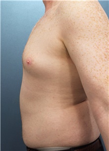 Liposuction Before Photo by Marvin Shienbaum, MD; Brandon, FL - Case 45715