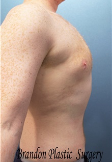 Liposuction After Photo by Marvin Shienbaum, MD; Brandon, FL - Case 45715