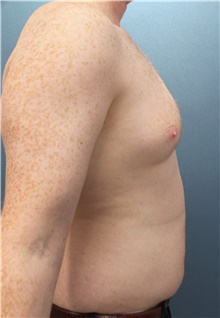 Liposuction Before Photo by Marvin Shienbaum, MD; Brandon, FL - Case 45715