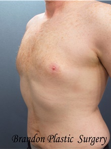 Liposuction After Photo by Marvin Shienbaum, MD; Brandon, FL - Case 45715