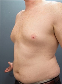 Liposuction Before Photo by Marvin Shienbaum, MD; Brandon, FL - Case 45715