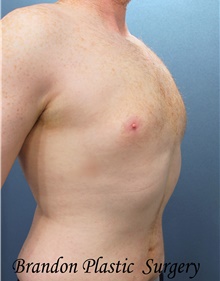 Liposuction After Photo by Marvin Shienbaum, MD; Brandon, FL - Case 45715