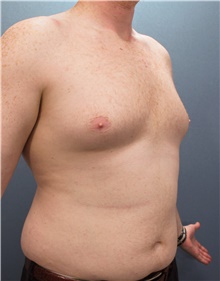 Liposuction Before Photo by Marvin Shienbaum, MD; Brandon, FL - Case 45715