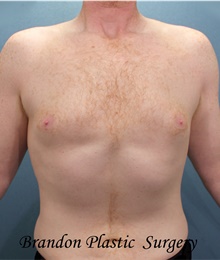 Liposuction After Photo by Marvin Shienbaum, MD; Brandon, FL - Case 45715