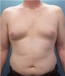 Liposuction Before Photo by Marvin Shienbaum, MD; Brandon, FL - Case 45715