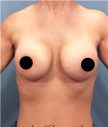 Breast Augmentation After Photo by Marvin Shienbaum, MD; Brandon, FL - Case 45805