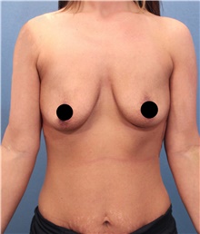 Breast Augmentation Before Photo by Marvin Shienbaum, MD; Brandon, FL - Case 45805