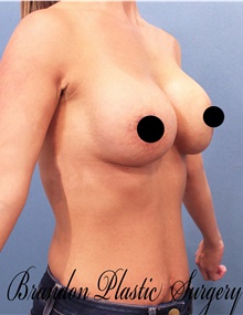 Breast Augmentation After Photo by Marvin Shienbaum, MD; Brandon, FL - Case 45805