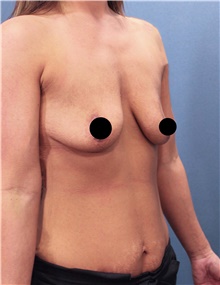 Breast Augmentation Before Photo by Marvin Shienbaum, MD; Brandon, FL - Case 45805