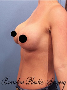 Breast Augmentation After Photo by Marvin Shienbaum, MD; Brandon, FL - Case 45805