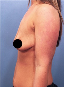 Breast Augmentation Before Photo by Marvin Shienbaum, MD; Brandon, FL - Case 45805