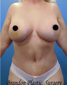 Tummy Tuck After Photo by Marvin Shienbaum, MD; Brandon, FL - Case 45847