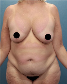 Tummy Tuck Before Photo by Marvin Shienbaum, MD; Brandon, FL - Case 45847