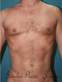 Liposuction After Photo by Marvin Shienbaum, MD; Brandon, FL - Case 45855