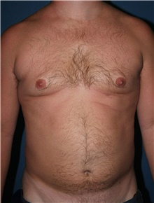 Liposuction Before Photo by Marvin Shienbaum, MD; Brandon, FL - Case 45855