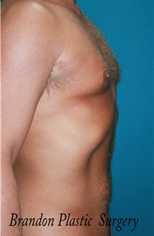 Liposuction After Photo by Marvin Shienbaum, MD; Brandon, FL - Case 45855