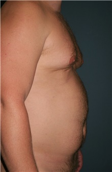 Liposuction Before Photo by Marvin Shienbaum, MD; Brandon, FL - Case 45855