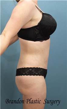 Tummy Tuck After Photo by Marvin Shienbaum, MD; Brandon, FL - Case 45866