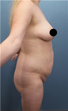 Tummy Tuck Before Photo by Marvin Shienbaum, MD; Brandon, FL - Case 45866