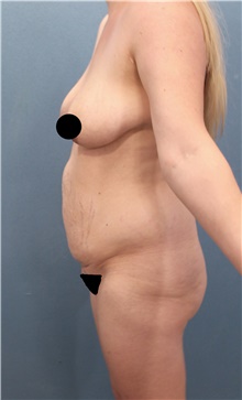 Tummy Tuck Before Photo by Marvin Shienbaum, MD; Brandon, FL - Case 45866