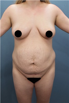 Tummy Tuck Before Photo by Marvin Shienbaum, MD; Brandon, FL - Case 45866