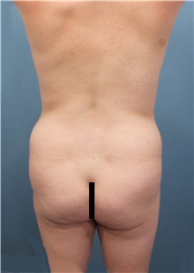 Tummy Tuck Before Photo by Marvin Shienbaum, MD; Brandon, FL - Case 45866