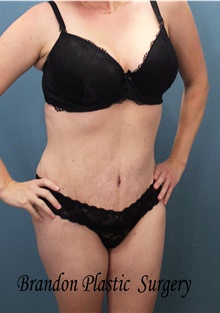 Tummy Tuck After Photo by Marvin Shienbaum, MD; Brandon, FL - Case 45866