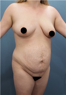 Tummy Tuck Before Photo by Marvin Shienbaum, MD; Brandon, FL - Case 45866