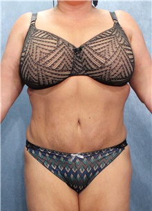 Tummy Tuck After Photo by Marvin Shienbaum, MD; Brandon, FL - Case 45870