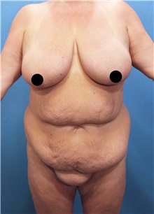 Tummy Tuck Before Photo by Marvin Shienbaum, MD; Brandon, FL - Case 45870