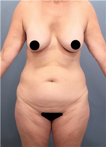 Tummy Tuck Before Photo by Marvin Shienbaum, MD; Brandon, FL - Case 45871