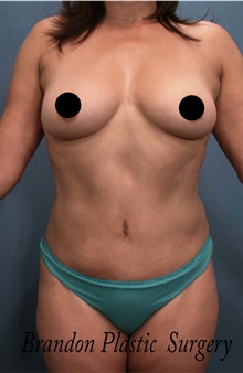 Tummy Tuck After Photo by Marvin Shienbaum, MD; Brandon, FL - Case 45873