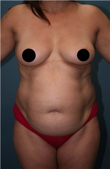 Tummy Tuck Before Photo by Marvin Shienbaum, MD; Brandon, FL - Case 45873