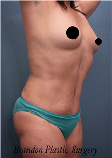 Tummy Tuck After Photo by Marvin Shienbaum, MD; Brandon, FL - Case 45873