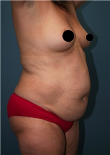 Tummy Tuck Before Photo by Marvin Shienbaum, MD; Brandon, FL - Case 45873