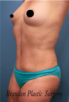 Tummy Tuck After Photo by Marvin Shienbaum, MD; Brandon, FL - Case 45873