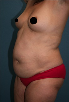 Tummy Tuck Before Photo by Marvin Shienbaum, MD; Brandon, FL - Case 45873