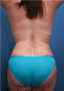 Tummy Tuck After Photo by Marvin Shienbaum, MD; Brandon, FL - Case 45873