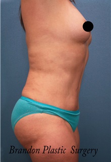 Tummy Tuck After Photo by Marvin Shienbaum, MD; Brandon, FL - Case 45873