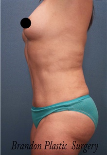 Tummy Tuck After Photo by Marvin Shienbaum, MD; Brandon, FL - Case 45873