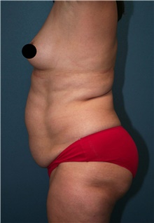 Tummy Tuck Before Photo by Marvin Shienbaum, MD; Brandon, FL - Case 45873